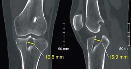 Loss of Normal Knee Motion After Anterior Cruciate Ligament Reconstruction Is Associated With Radiographic Arthritic Changes After Surgery
