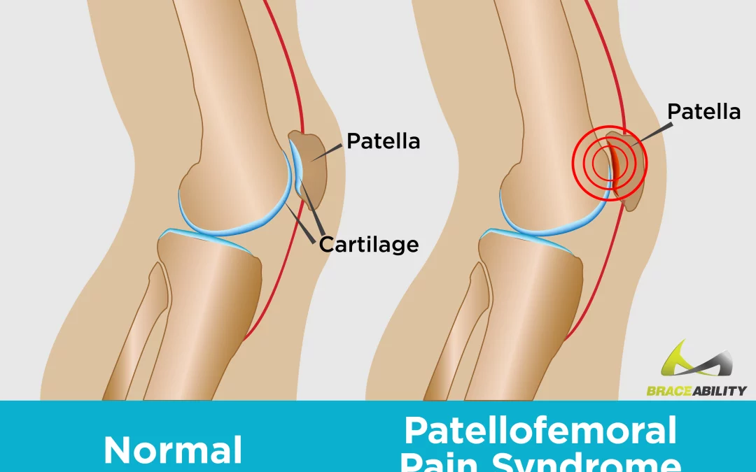 2016 Patellofemoral pain consensus statement from the 4th International Patellofemoral Pain Research Retreat, Manchester